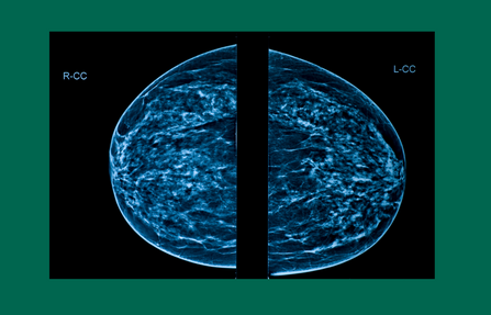 breast density image